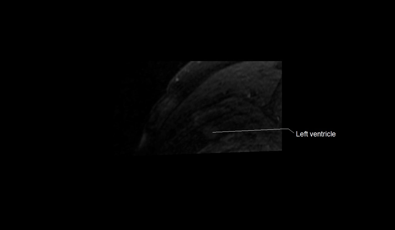 MRI heart and coronary arteries short axis anatomy image 42.webp